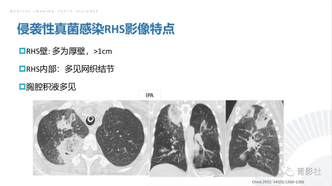 影像PPT - 【PPT】肺部反晕征影像诊断思维-41