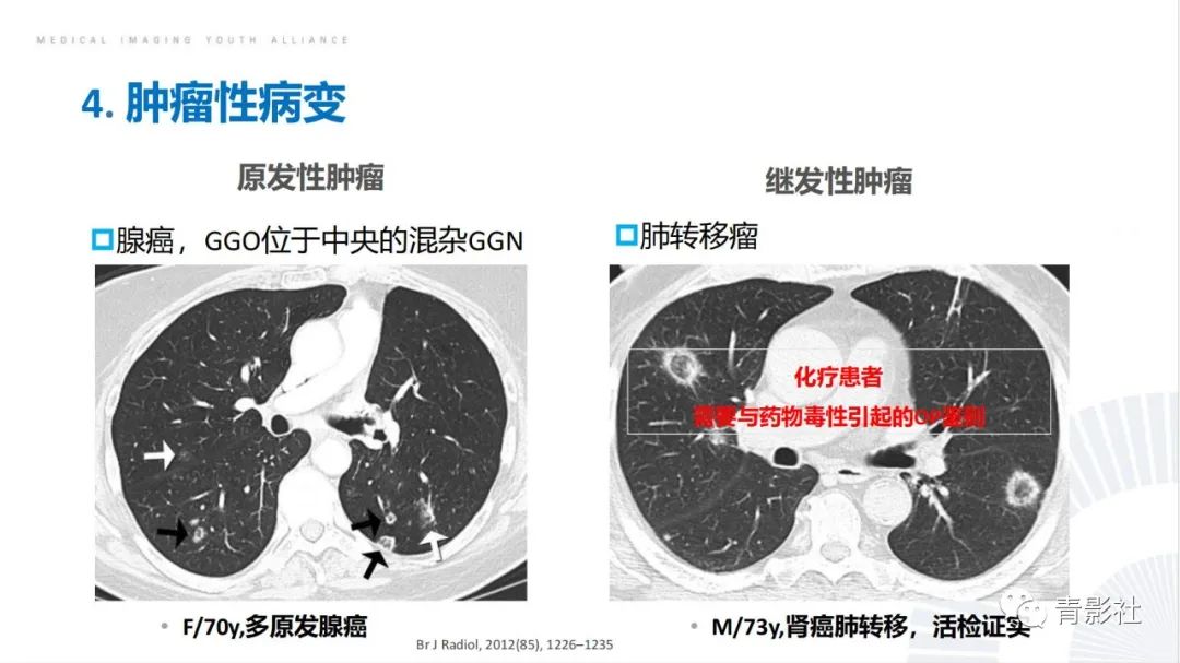 影像PPT - 【PPT】肺部反晕征影像诊断思维-42