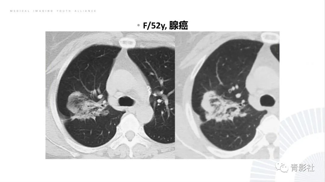 影像PPT - 【PPT】肺部反晕征影像诊断思维-43