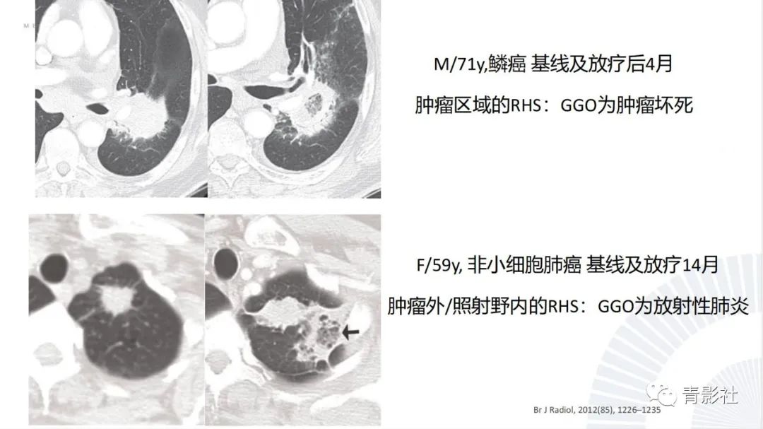影像PPT - 【PPT】肺部反晕征影像诊断思维-46