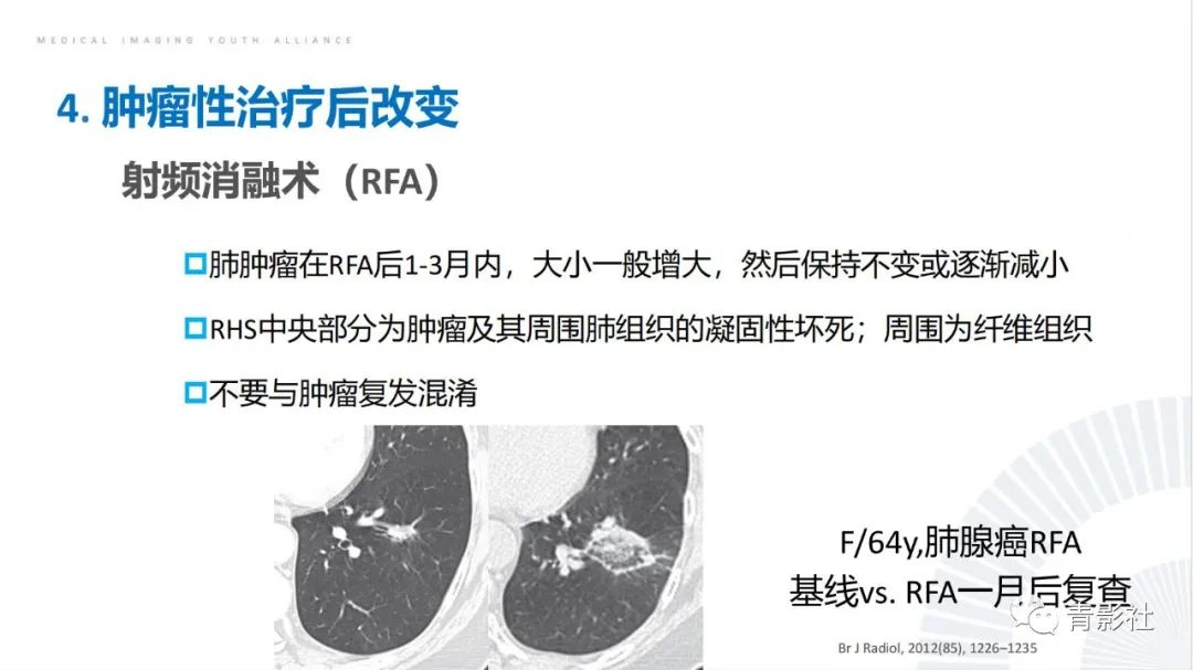 影像PPT - 【PPT】肺部反晕征影像诊断思维-44