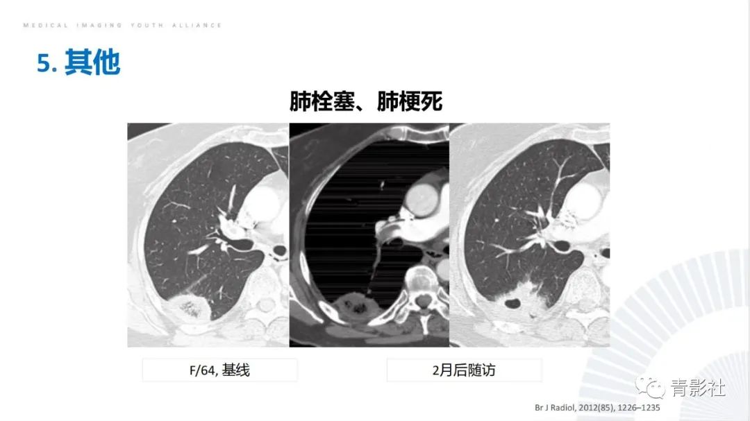 影像PPT - 【PPT】肺部反晕征影像诊断思维-47