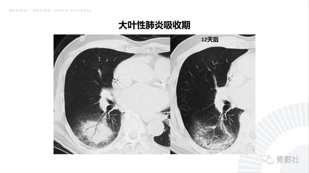 影像PPT - 【PPT】肺部反晕征影像诊断思维-48