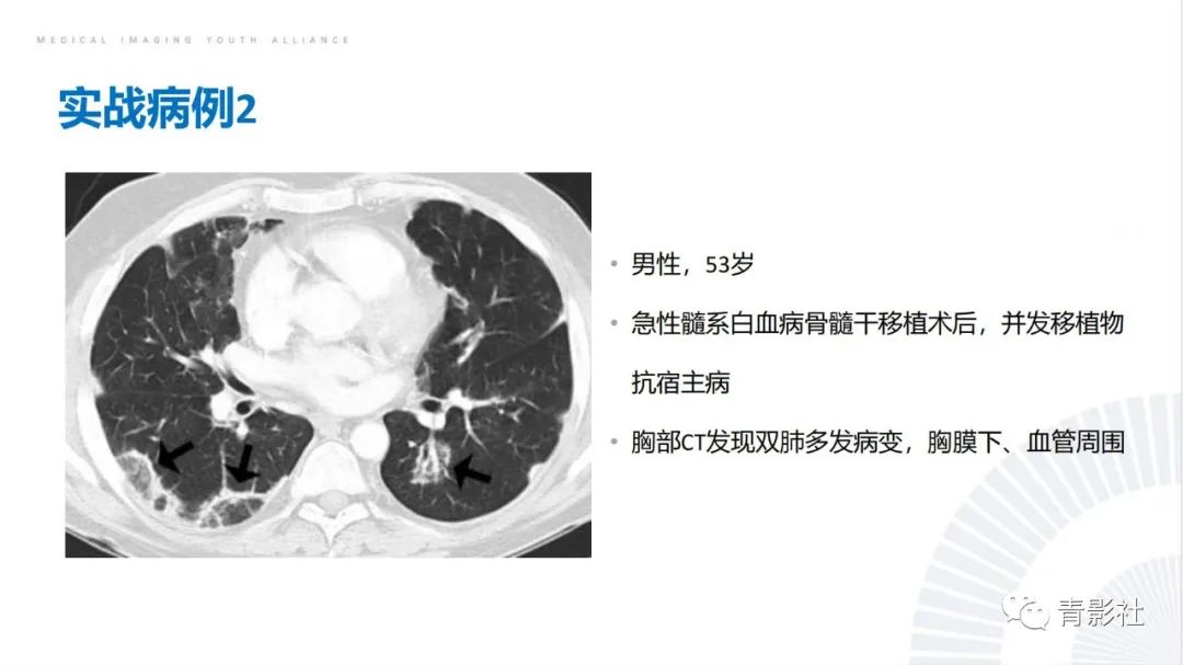 影像PPT - 【PPT】肺部反晕征影像诊断思维-54