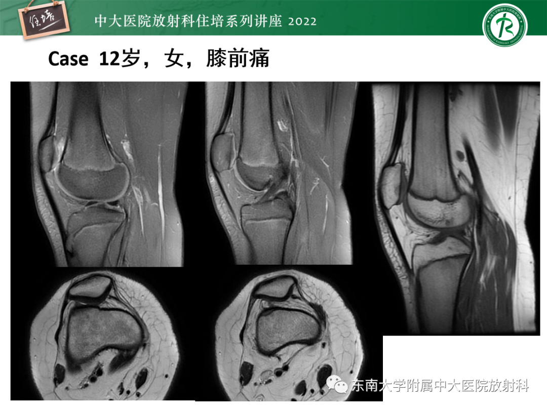 影像PPT - 【PPT】髌骨不稳与髌骨脱位影像学评估-1