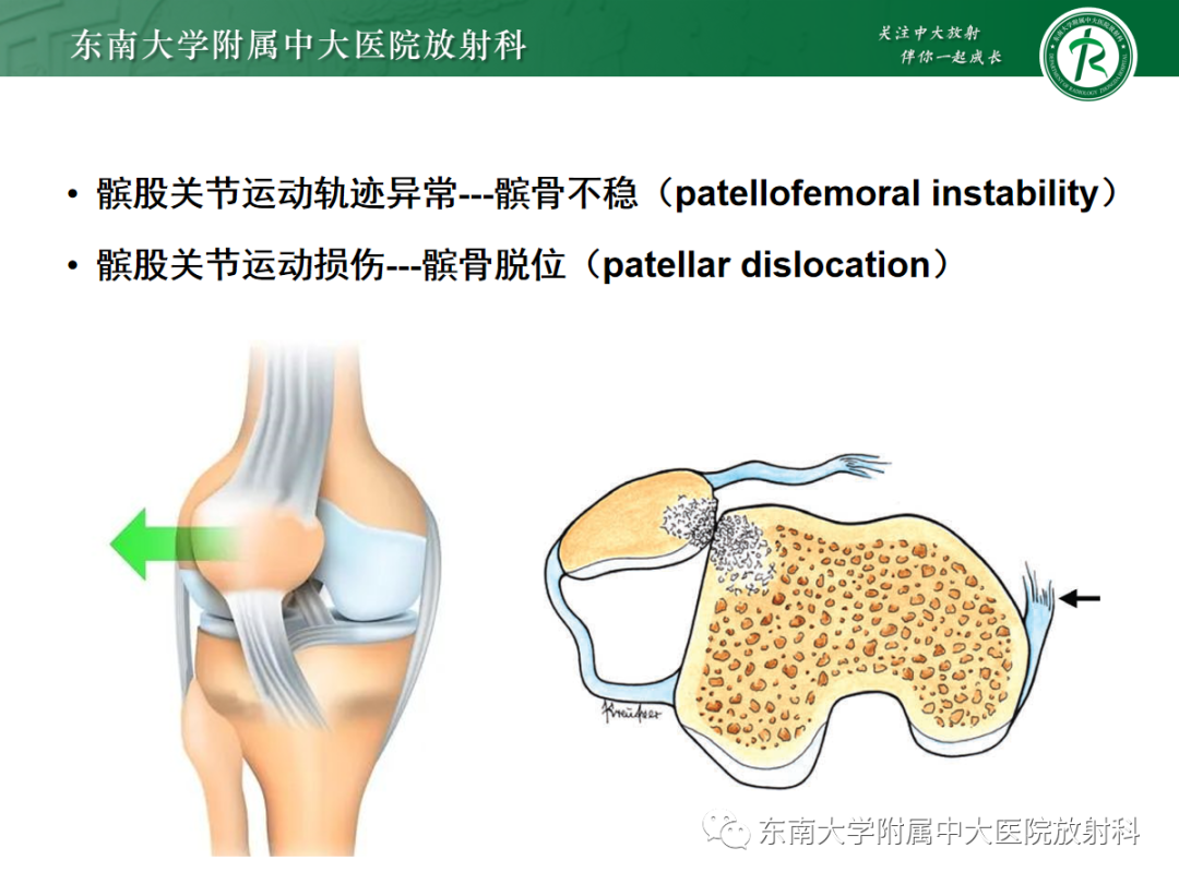 影像PPT - 【PPT】髌骨不稳与髌骨脱位影像学评估-3
