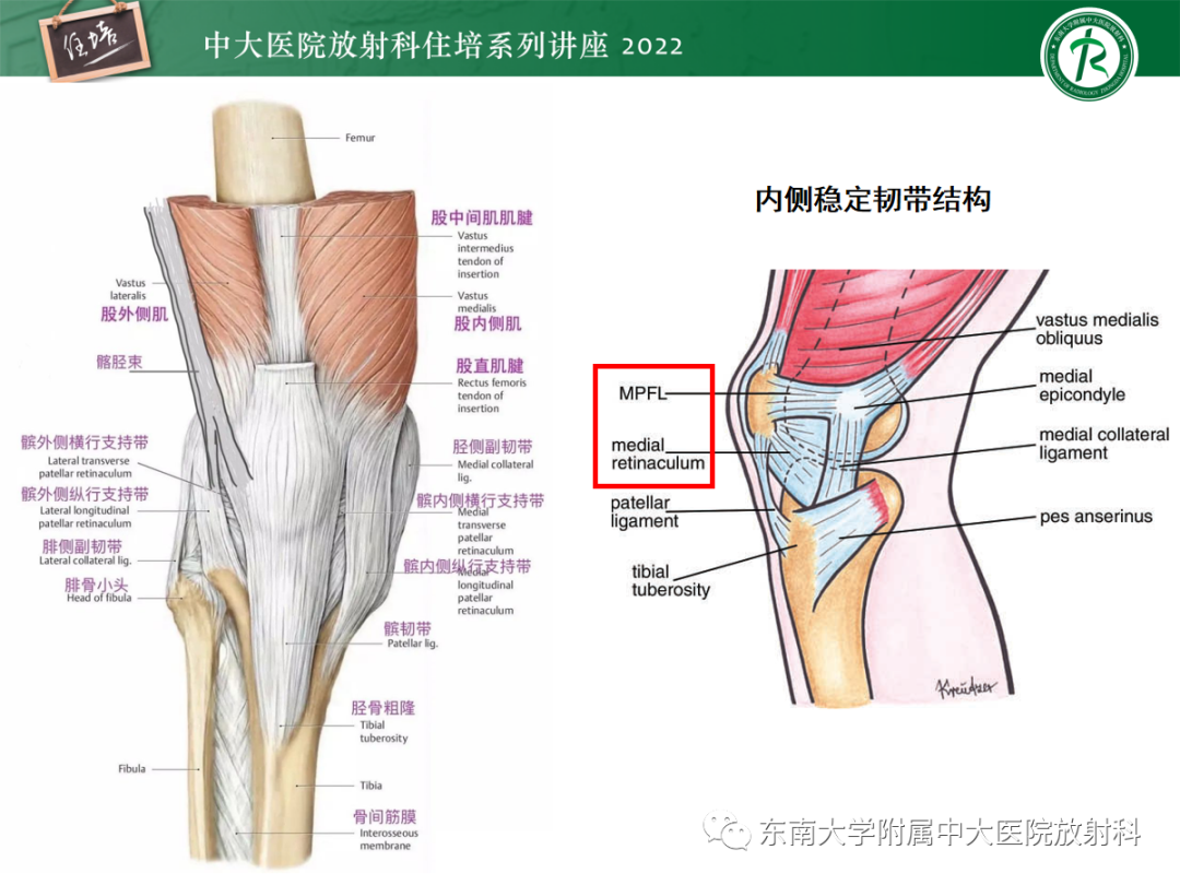影像PPT - 【PPT】髌骨不稳与髌骨脱位影像学评估-11