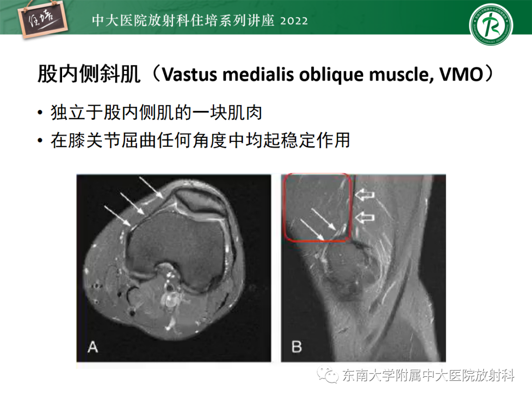 影像PPT - 【PPT】髌骨不稳与髌骨脱位影像学评估-12