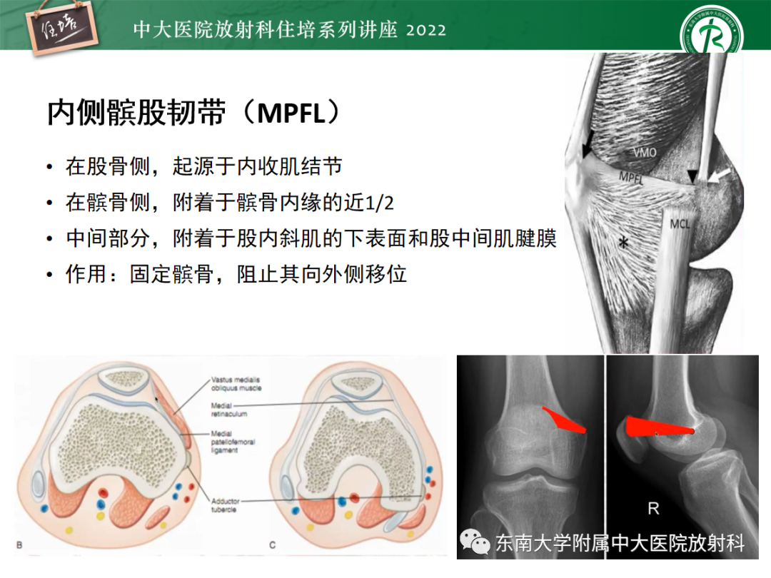 影像PPT - 【PPT】髌骨不稳与髌骨脱位影像学评估-13