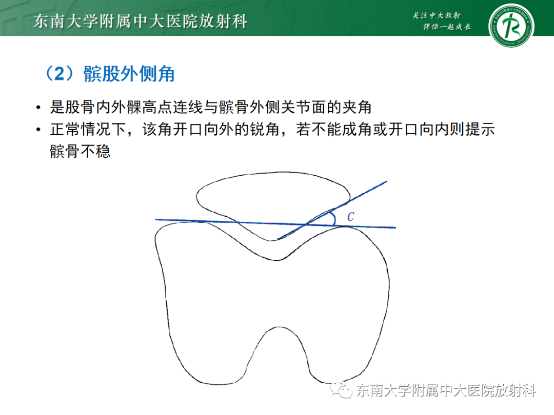 影像PPT - 【PPT】髌骨不稳与髌骨脱位影像学评估-18