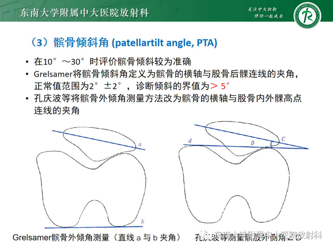 影像PPT - 【PPT】髌骨不稳与髌骨脱位影像学评估-19