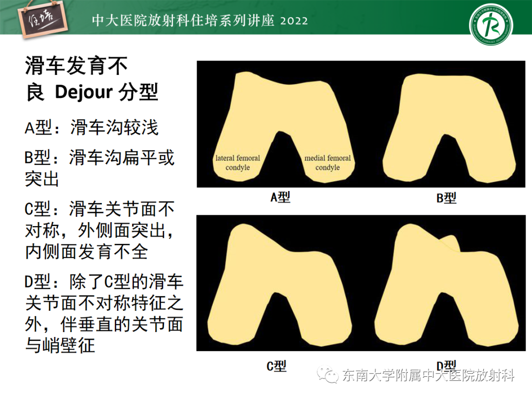 影像PPT - 【PPT】髌骨不稳与髌骨脱位影像学评估-23