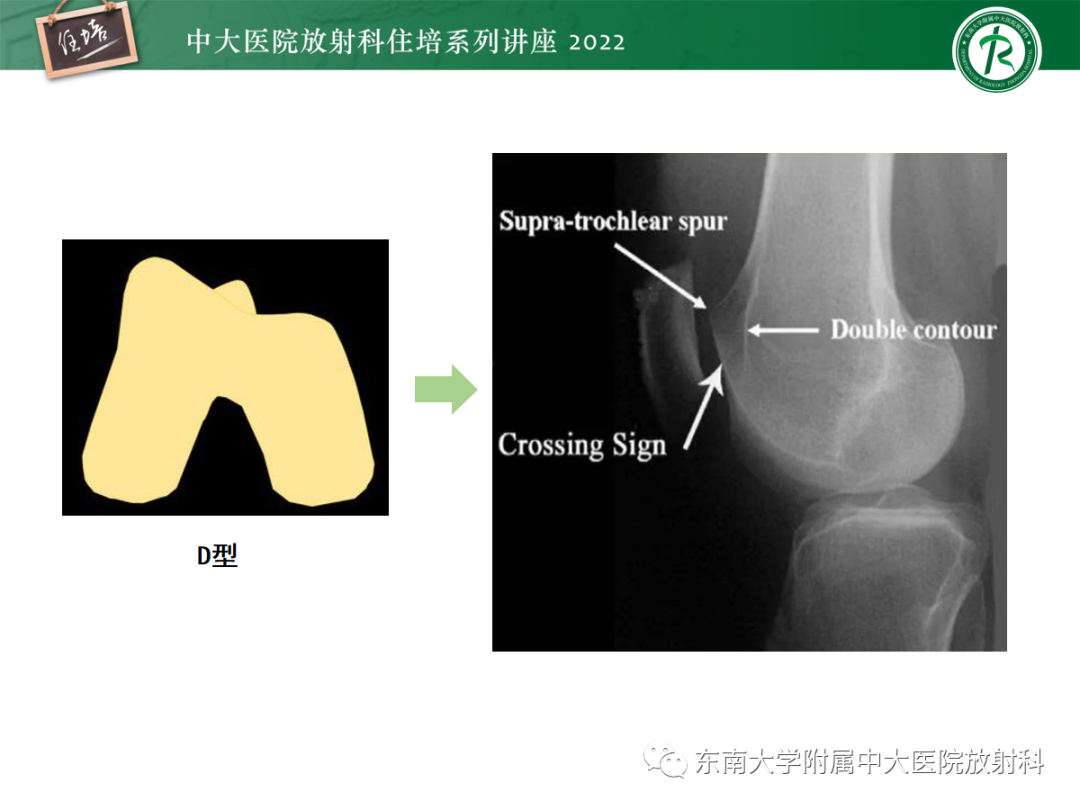 影像PPT - 【PPT】髌骨不稳与髌骨脱位影像学评估-24