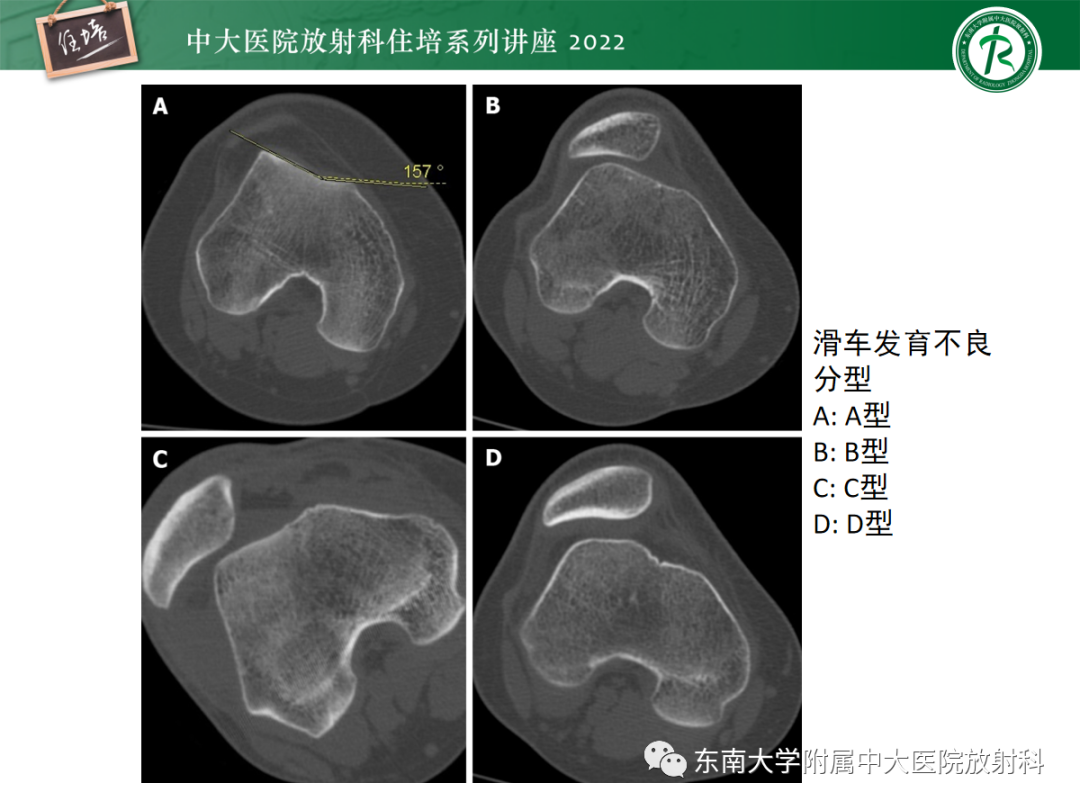 影像PPT - 【PPT】髌骨不稳与髌骨脱位影像学评估-25