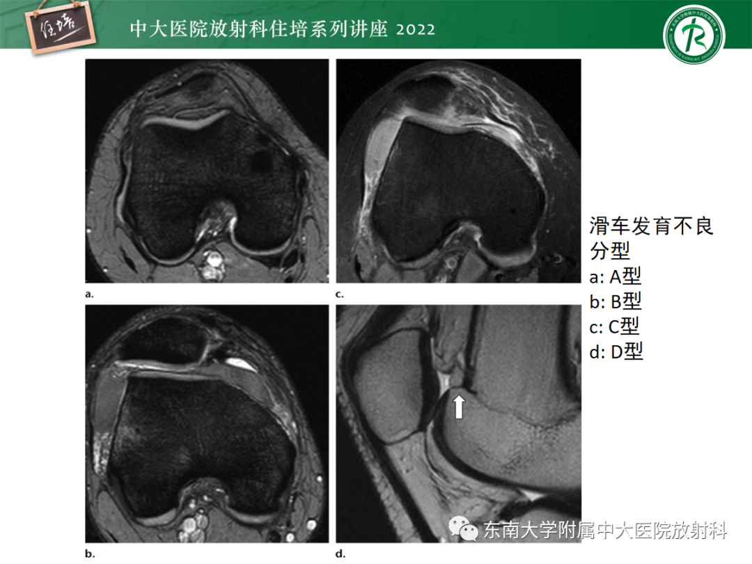 影像PPT - 【PPT】髌骨不稳与髌骨脱位影像学评估-26