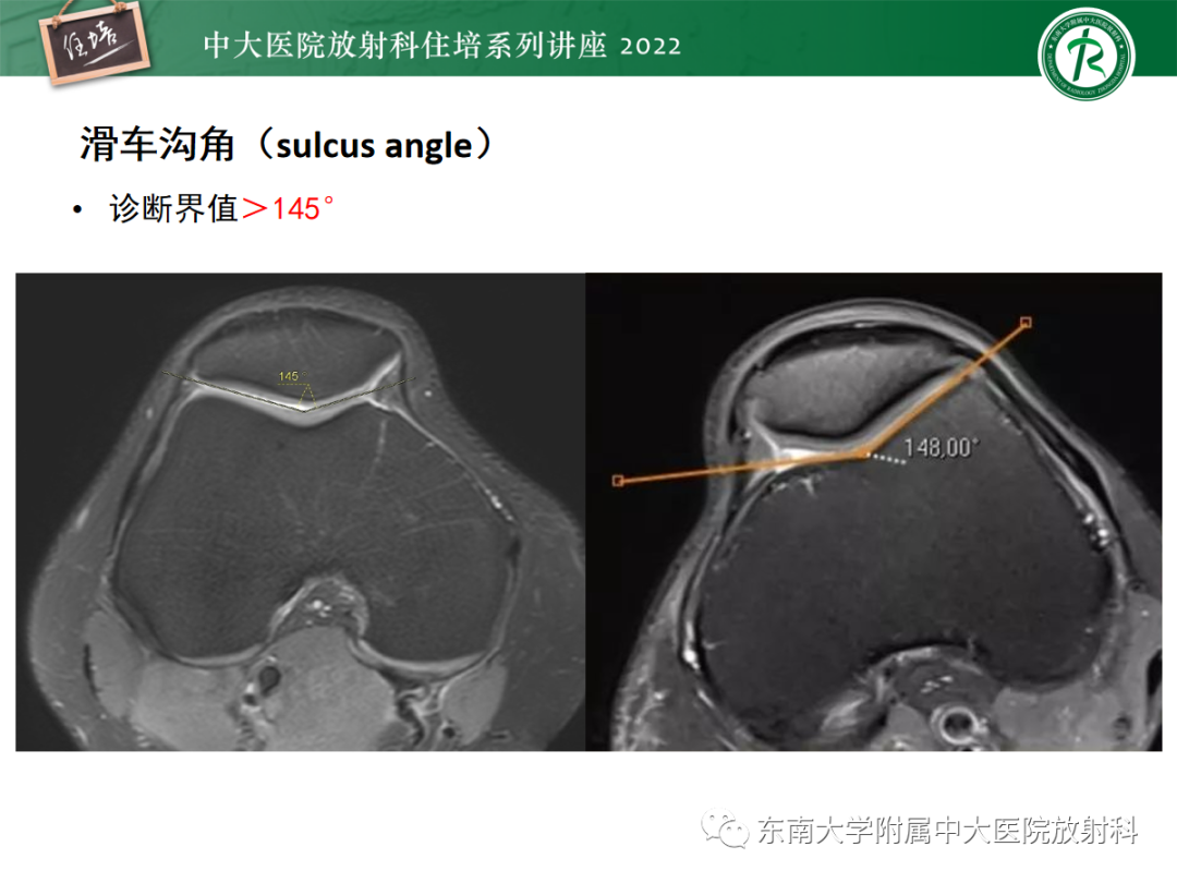 影像PPT - 【PPT】髌骨不稳与髌骨脱位影像学评估-27