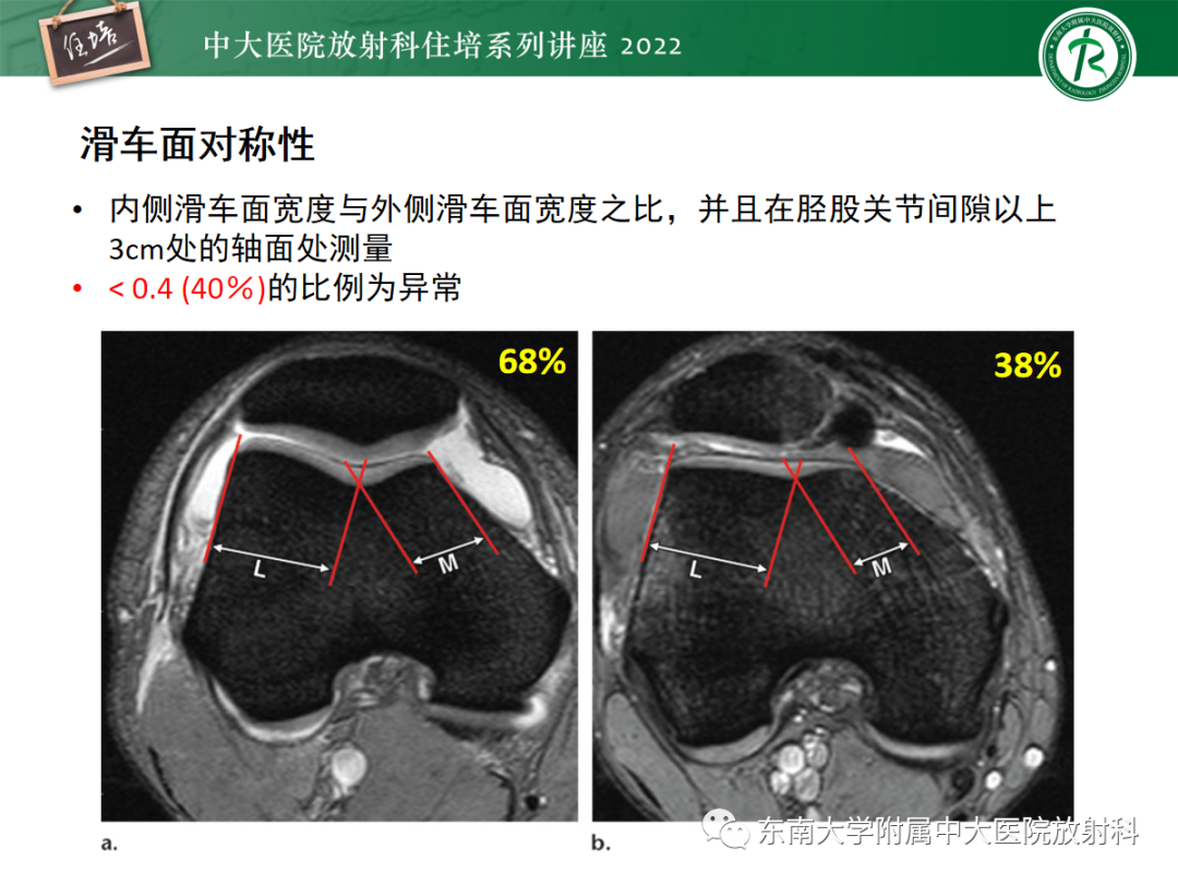 影像PPT - 【PPT】髌骨不稳与髌骨脱位影像学评估-29