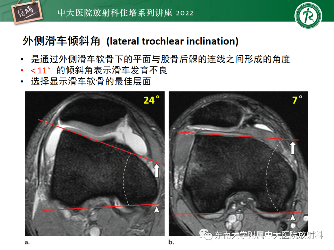 影像PPT - 【PPT】髌骨不稳与髌骨脱位影像学评估-28