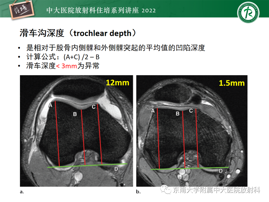 影像PPT - 【PPT】髌骨不稳与髌骨脱位影像学评估-30