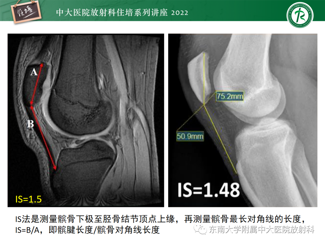 影像PPT - 【PPT】髌骨不稳与髌骨脱位影像学评估-32