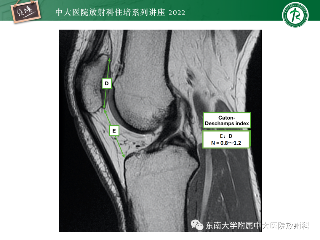 影像PPT - 【PPT】髌骨不稳与髌骨脱位影像学评估-33