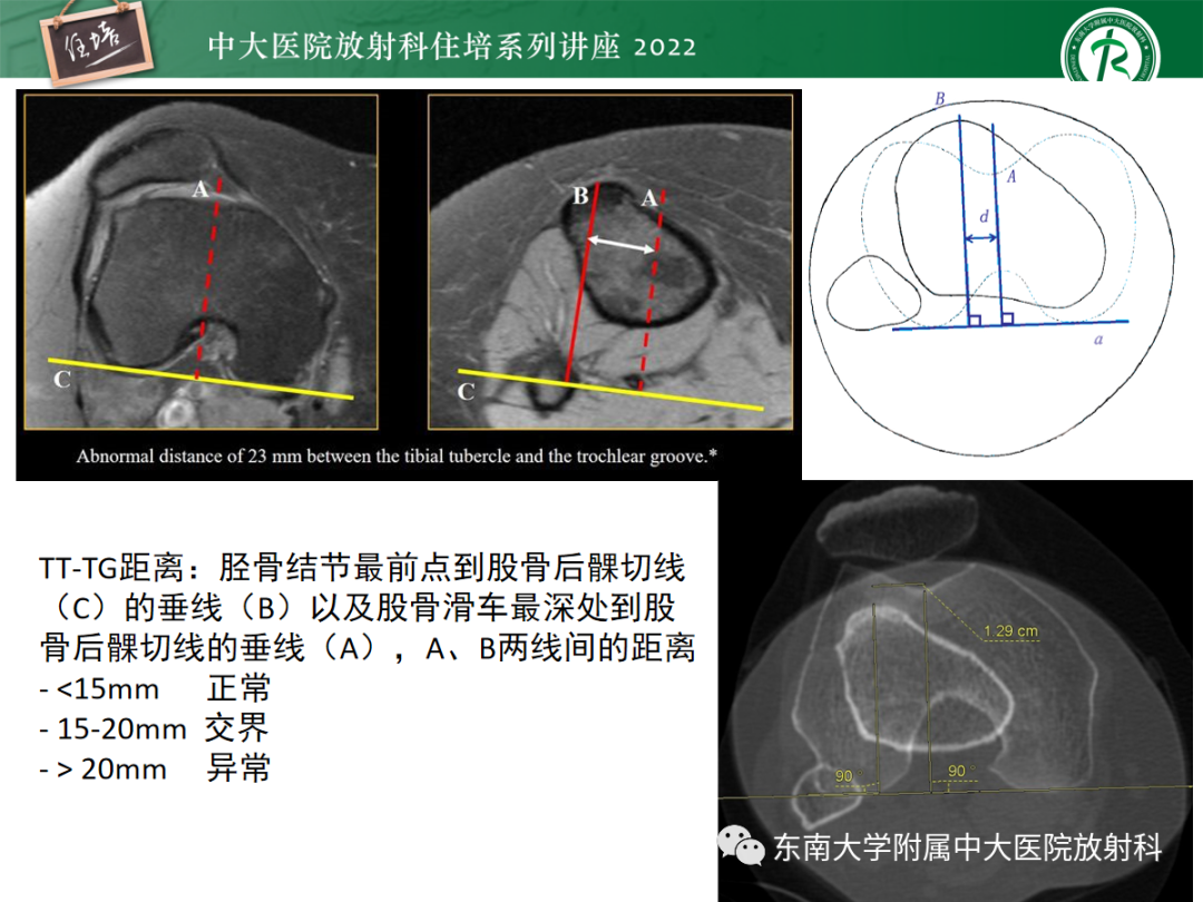 影像PPT - 【PPT】髌骨不稳与髌骨脱位影像学评估-35