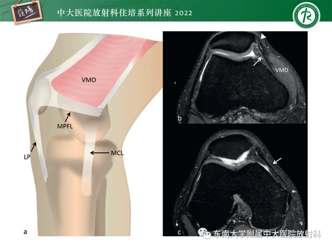 影像PPT - 【PPT】髌骨不稳与髌骨脱位影像学评估-37