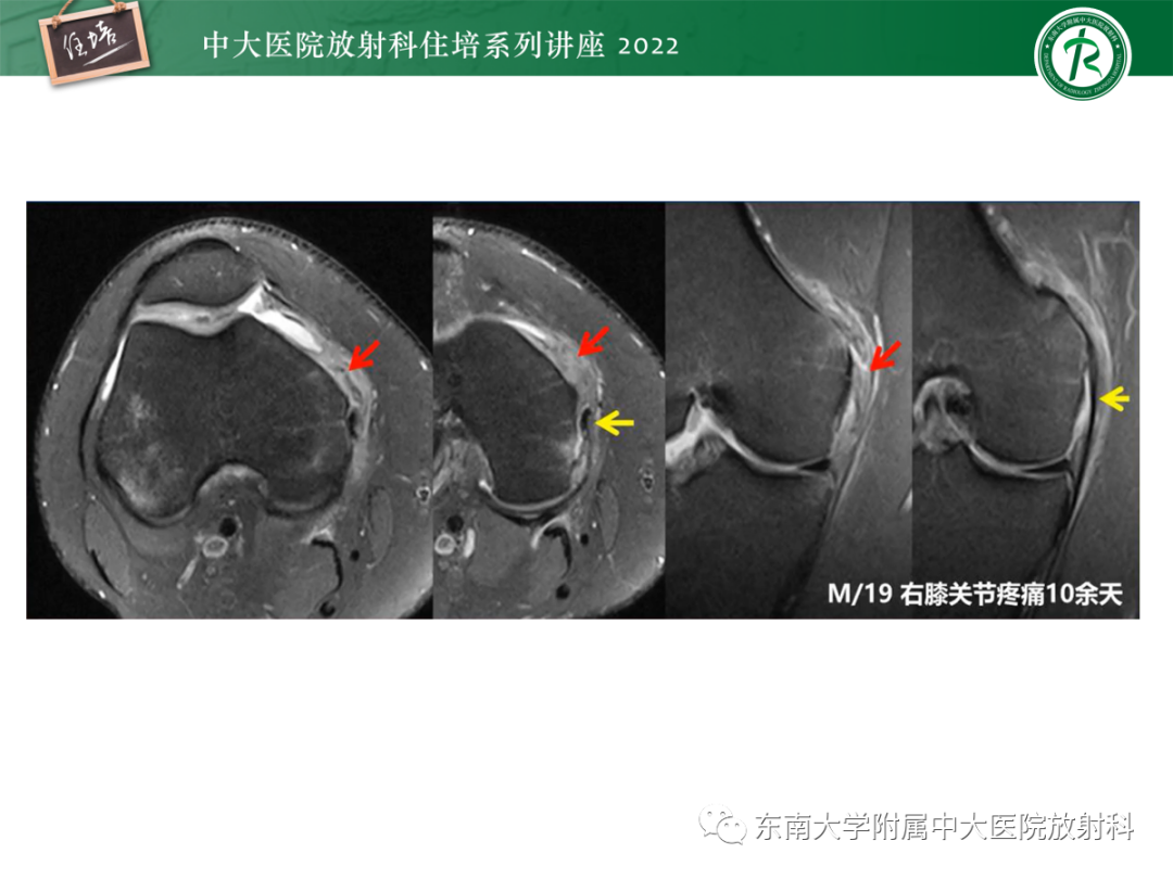 影像PPT - 【PPT】髌骨不稳与髌骨脱位影像学评估-38