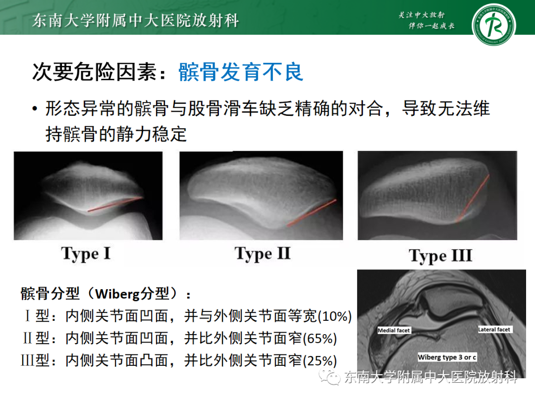影像PPT - 【PPT】髌骨不稳与髌骨脱位影像学评估-39