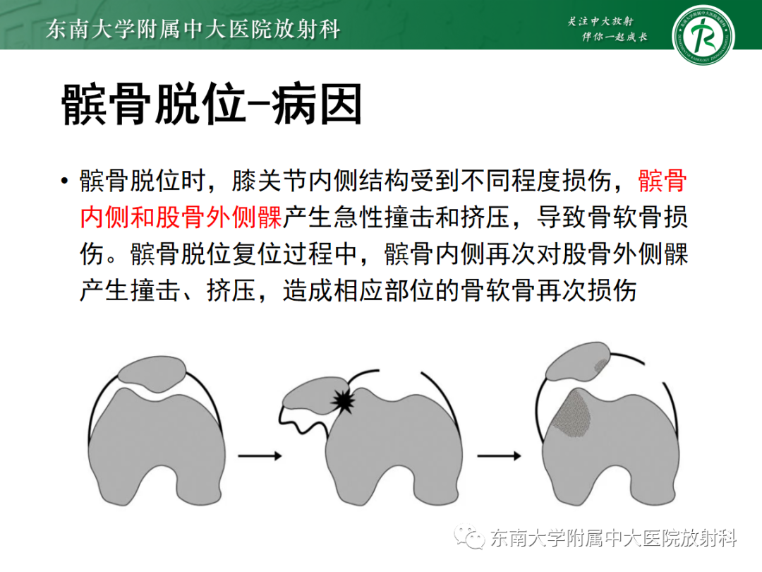 影像PPT - 【PPT】髌骨不稳与髌骨脱位影像学评估-43