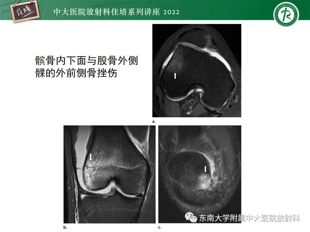 影像PPT - 【PPT】髌骨不稳与髌骨脱位影像学评估-46