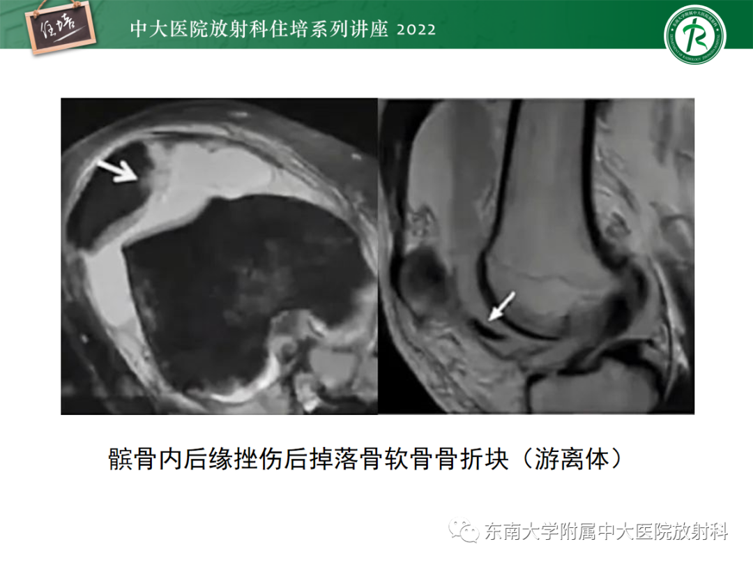 影像PPT - 【PPT】髌骨不稳与髌骨脱位影像学评估-47