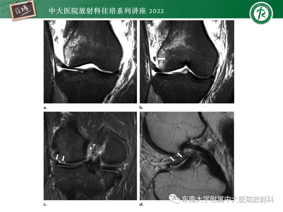 影像PPT - 【PPT】髌骨不稳与髌骨脱位影像学评估-48