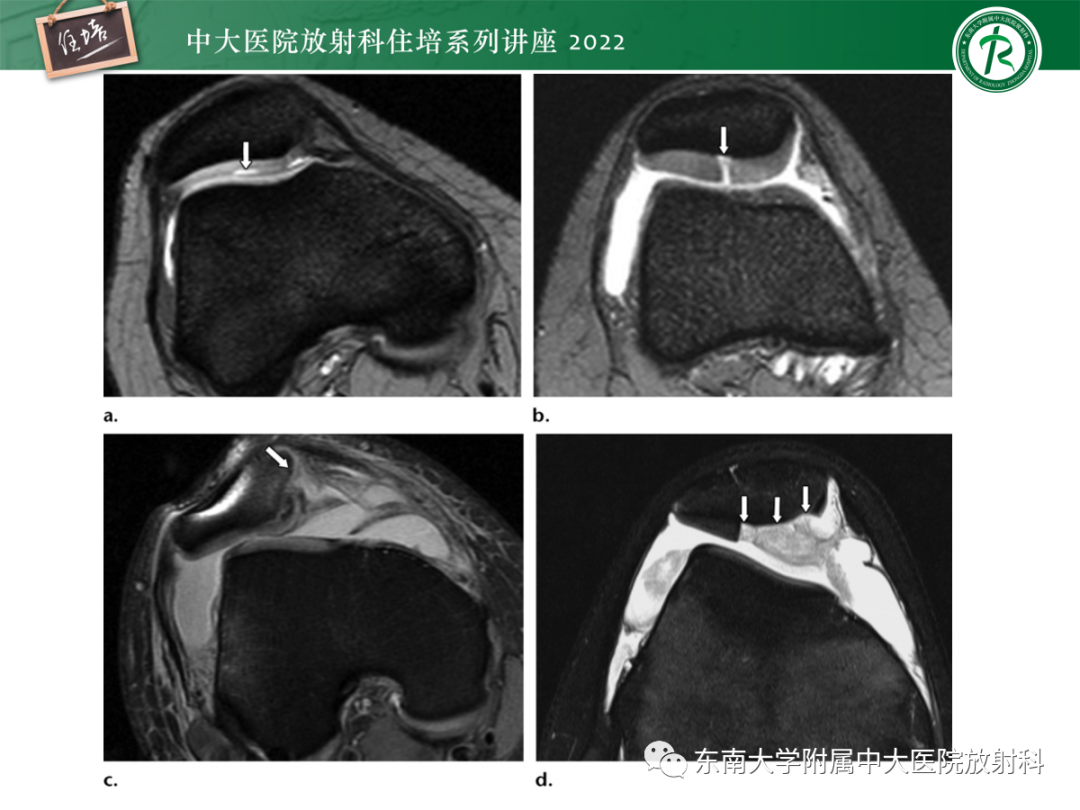 影像PPT - 【PPT】髌骨不稳与髌骨脱位影像学评估-49
