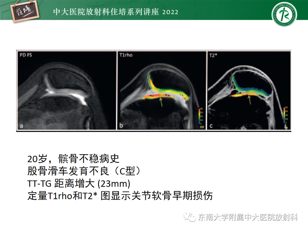 影像PPT - 【PPT】髌骨不稳与髌骨脱位影像学评估-50