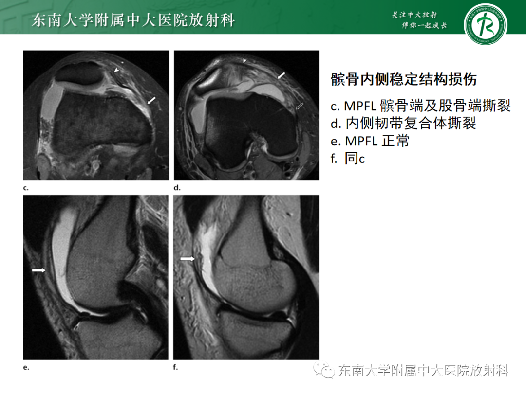 影像PPT - 【PPT】髌骨不稳与髌骨脱位影像学评估-52