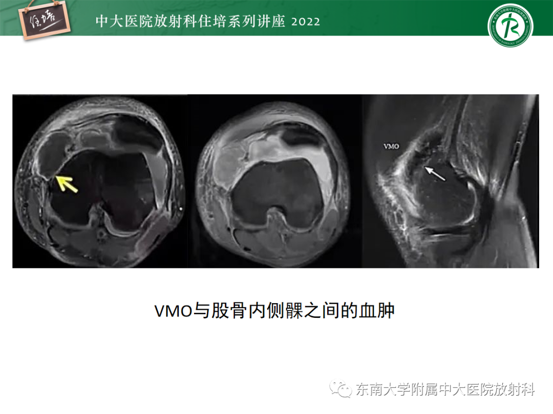 影像PPT - 【PPT】髌骨不稳与髌骨脱位影像学评估-53