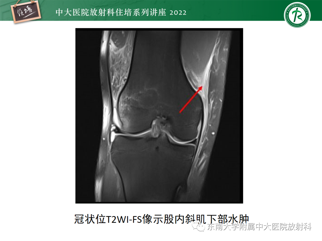 影像PPT - 【PPT】髌骨不稳与髌骨脱位影像学评估-54