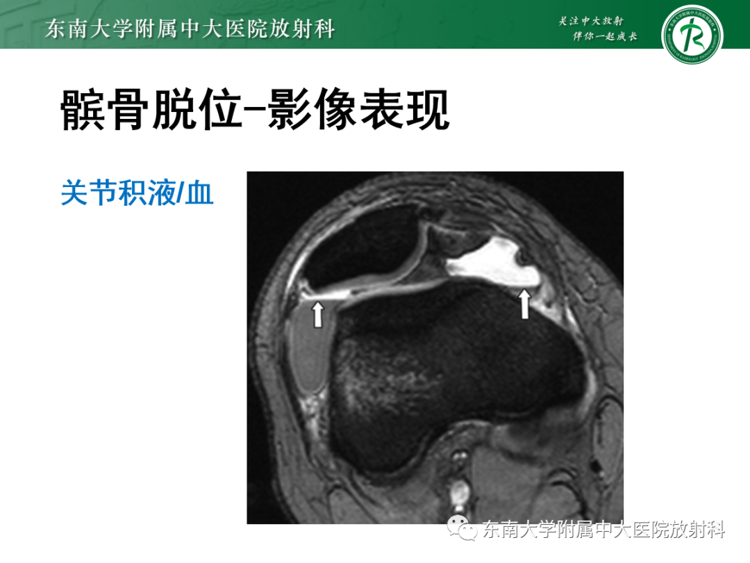 影像PPT - 【PPT】髌骨不稳与髌骨脱位影像学评估-55