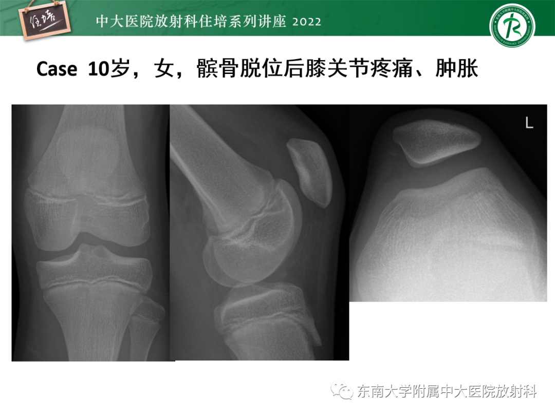 影像PPT - 【PPT】髌骨不稳与髌骨脱位影像学评估-57