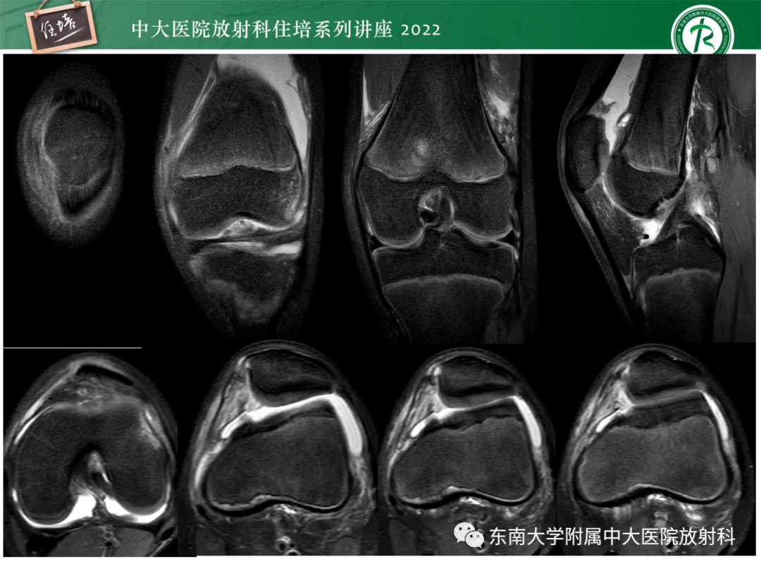 影像PPT - 【PPT】髌骨不稳与髌骨脱位影像学评估-58