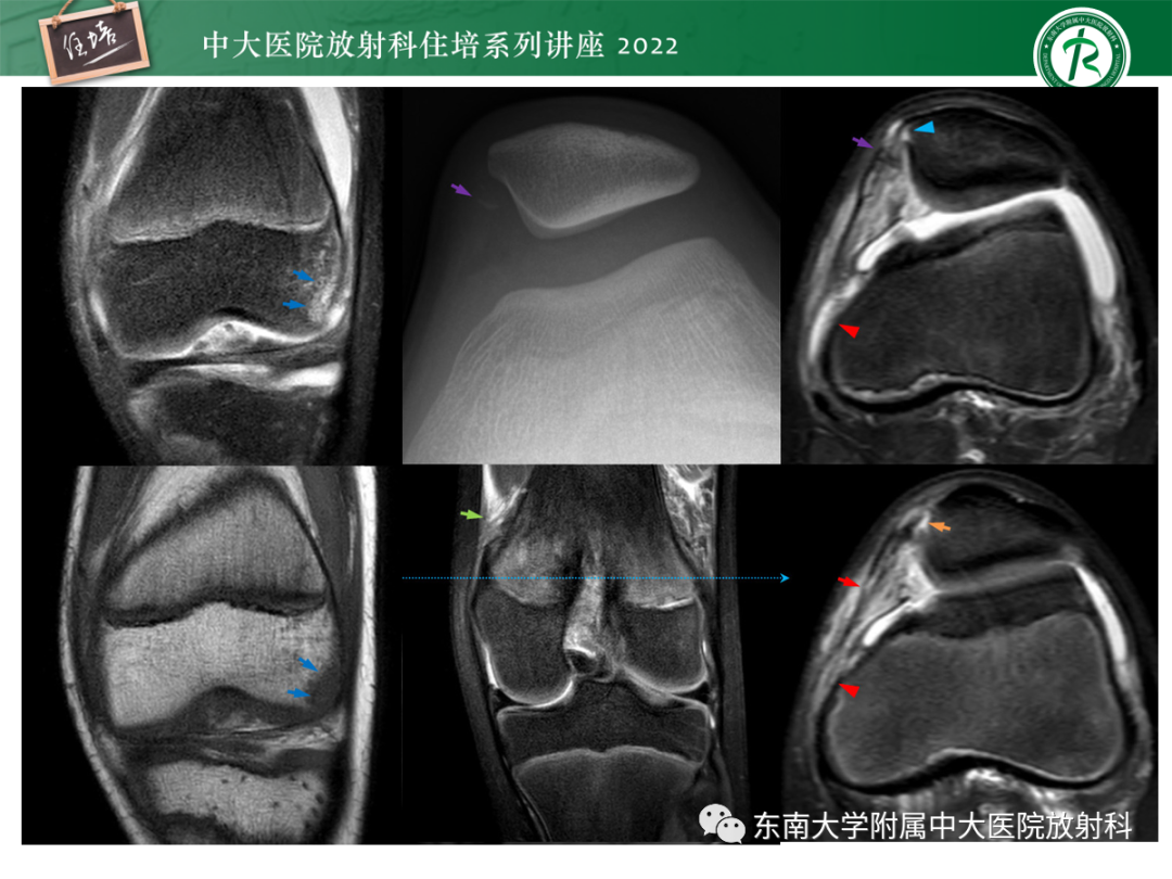 影像PPT - 【PPT】髌骨不稳与髌骨脱位影像学评估-59
