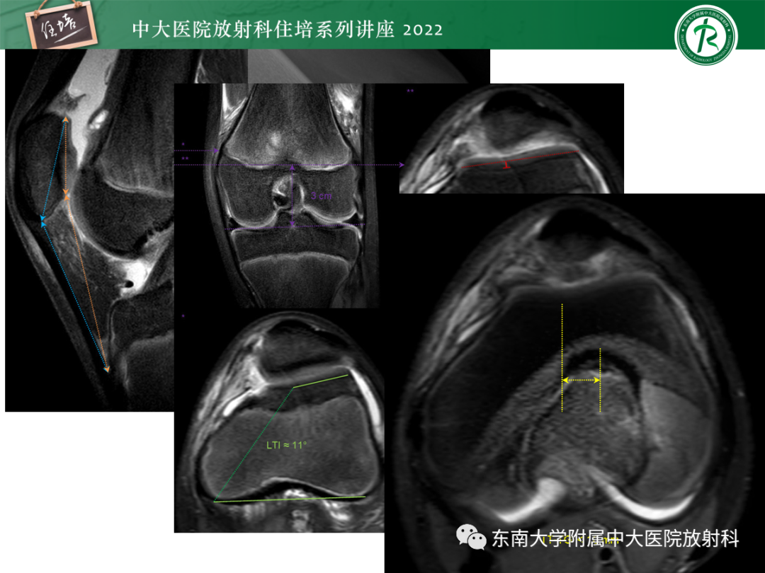 影像PPT - 【PPT】髌骨不稳与髌骨脱位影像学评估-60