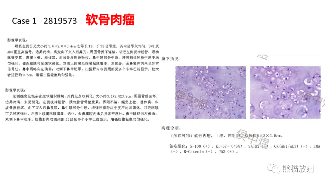 影像PPT - 【病例】颅底软骨肉瘤 VS 脊索瘤-16