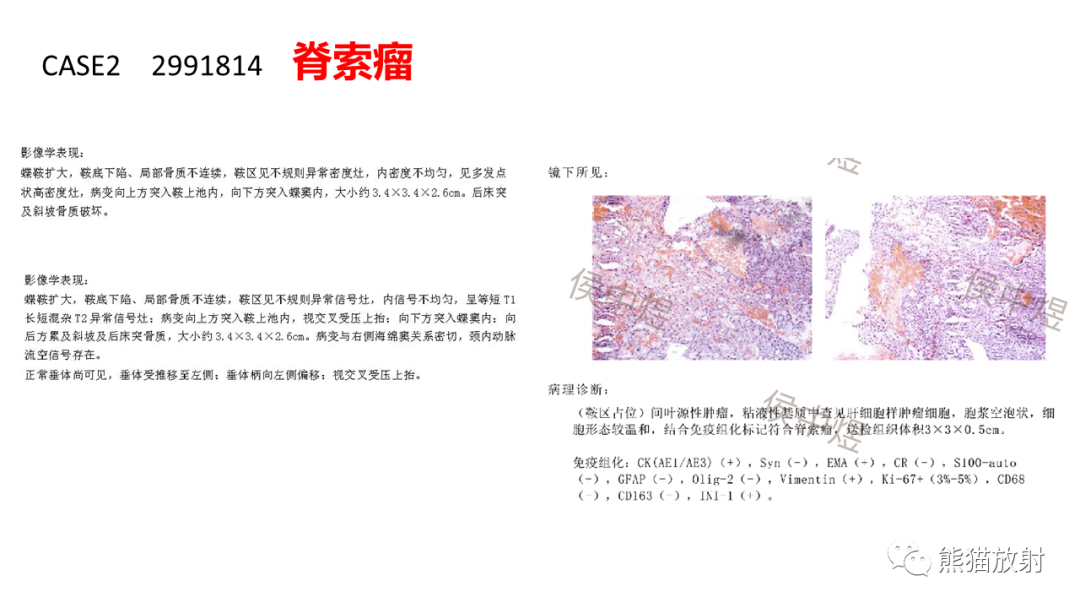 影像PPT - 【病例】颅底软骨肉瘤 VS 脊索瘤-18