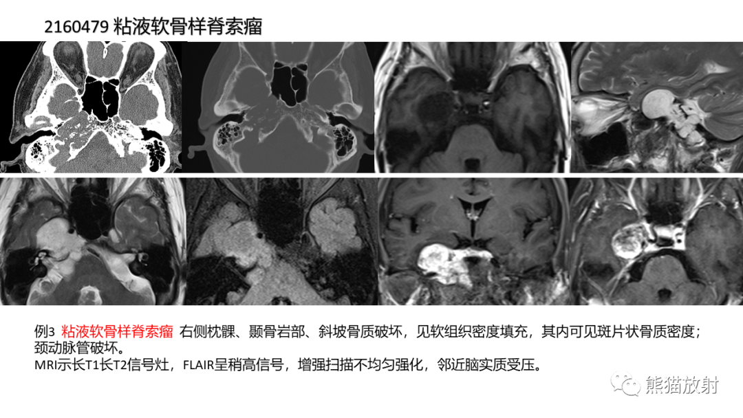 影像PPT - 【病例】颅底软骨肉瘤 VS 脊索瘤-30