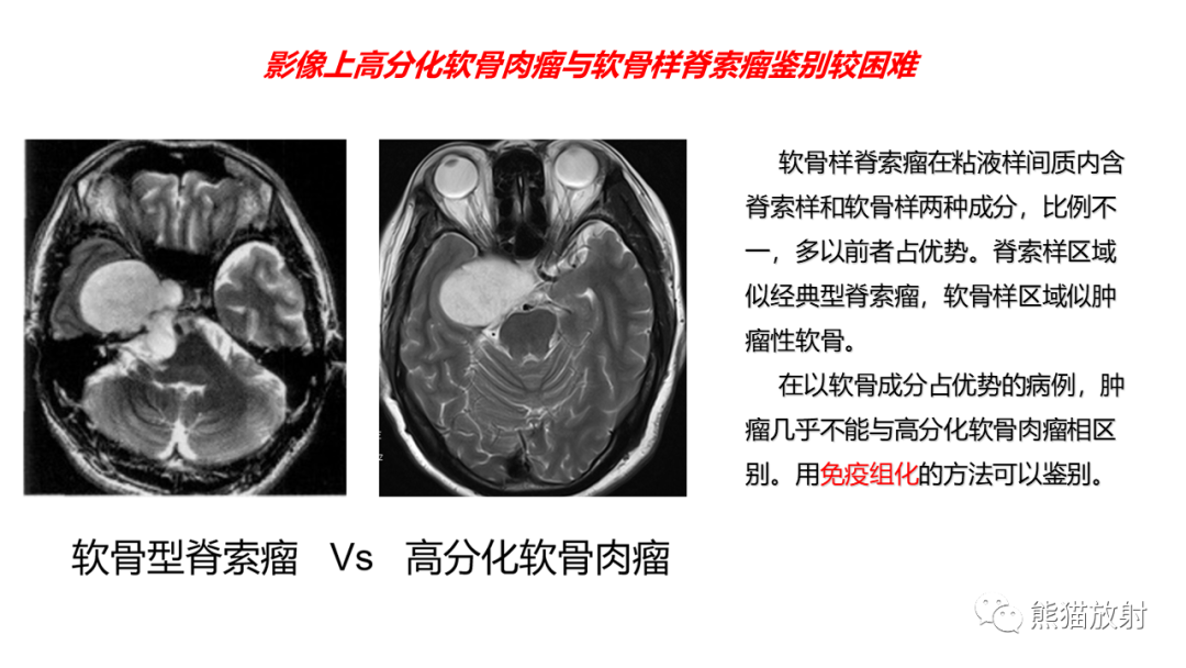 影像PPT - 【病例】颅底软骨肉瘤 VS 脊索瘤-32