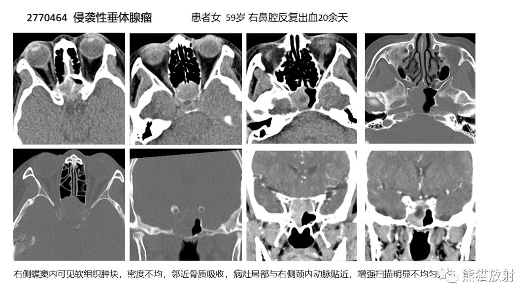 影像PPT - 【病例】颅底软骨肉瘤 VS 脊索瘤-35