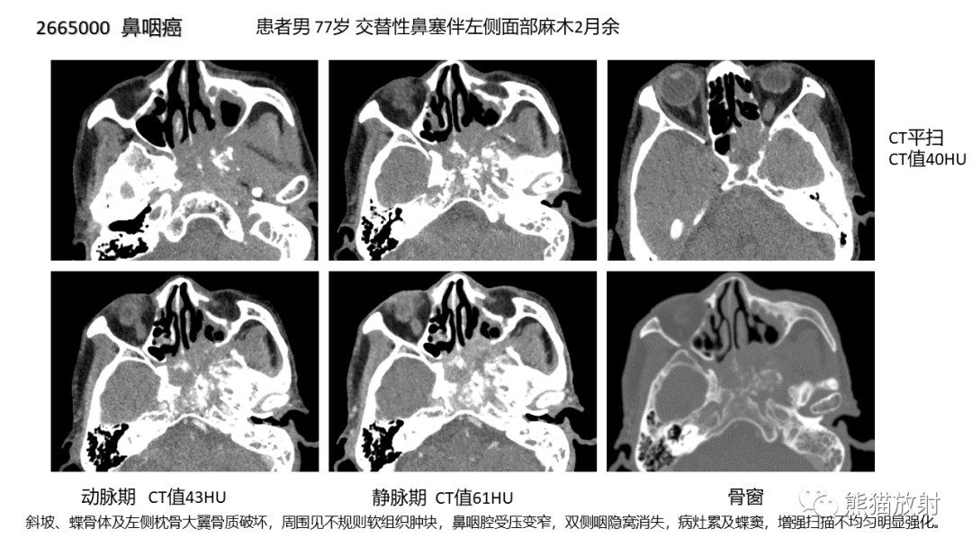 影像PPT - 【病例】颅底软骨肉瘤 VS 脊索瘤-38