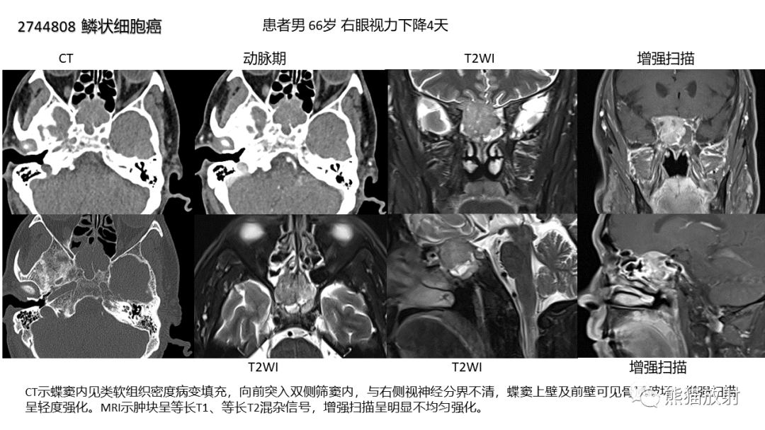 影像PPT - 【病例】颅底软骨肉瘤 VS 脊索瘤-41